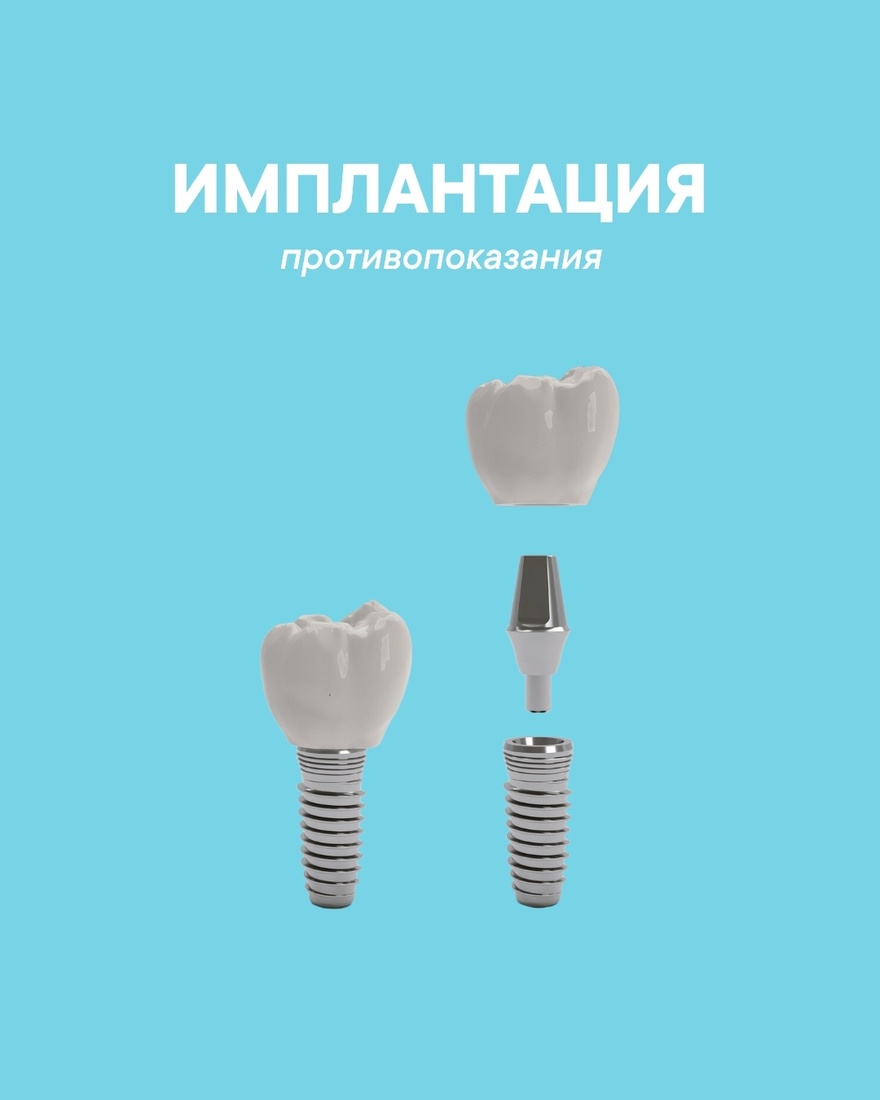 Что нужно знать о противопоказаниях к установке зубных имплантов?