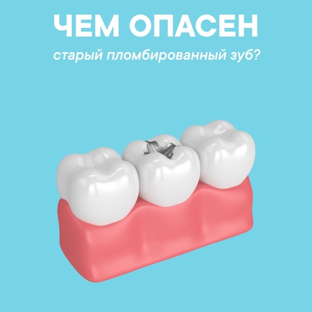 Чем опасен «старый пломбированный зуб»?
