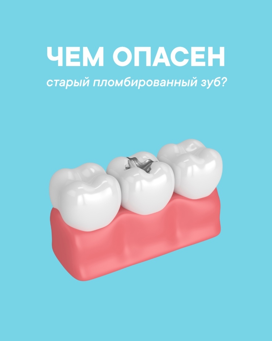 Чем опасен «старый пломбированный зуб»?