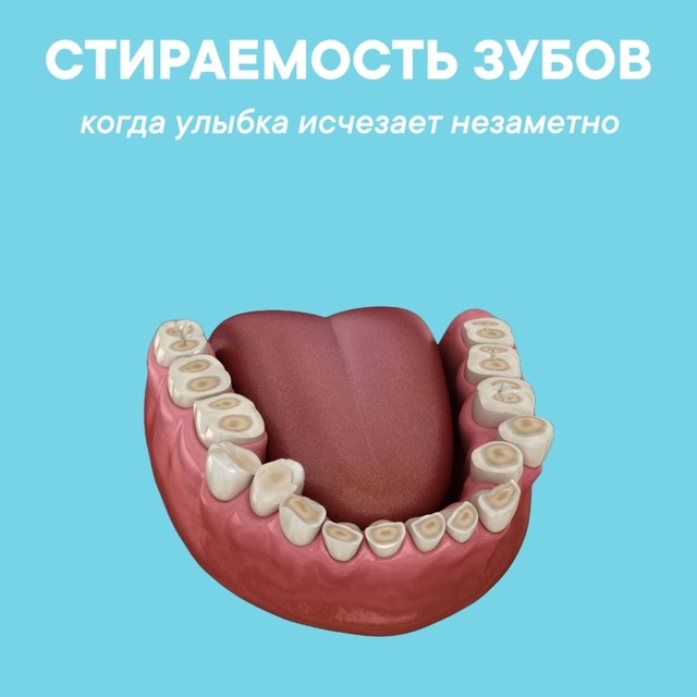 Стираемость зубов: незаметная проблема с серьёзными последствиями