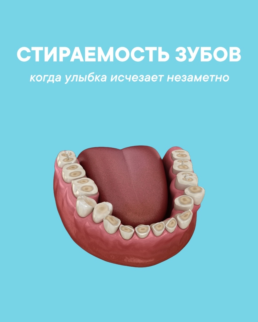 Стираемость зубов: незаметная проблема с серьёзными последствиями